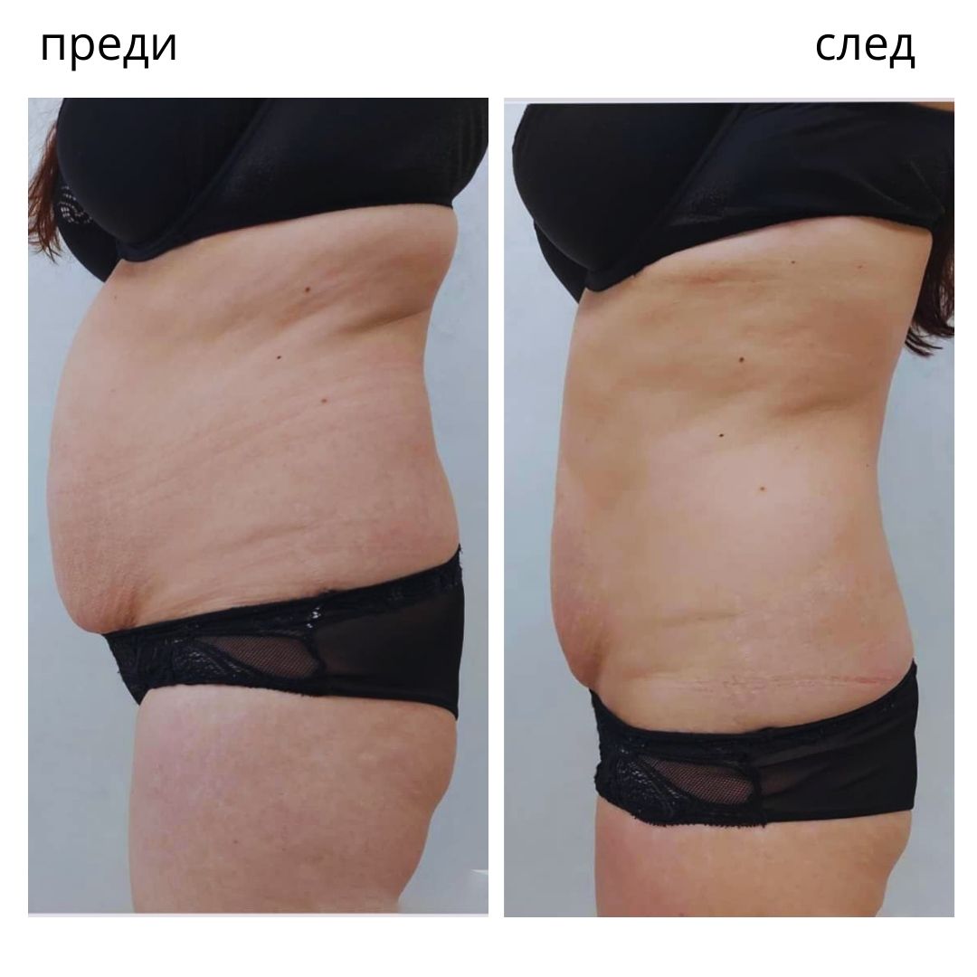 PowerShape 2 резултат преди и след, оформяне на корема в Бургас