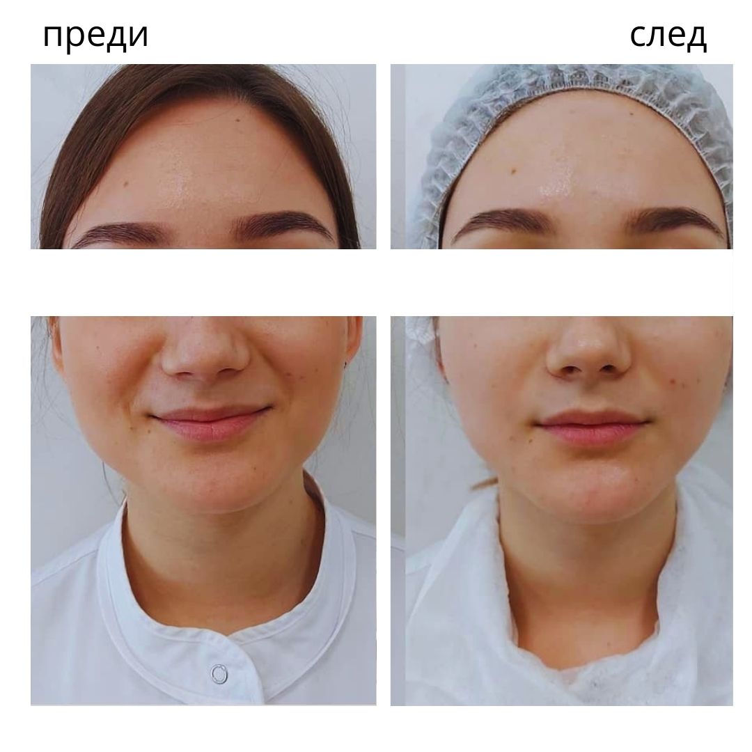 PowerShape 2 резултат след 2 процедури в Бургас